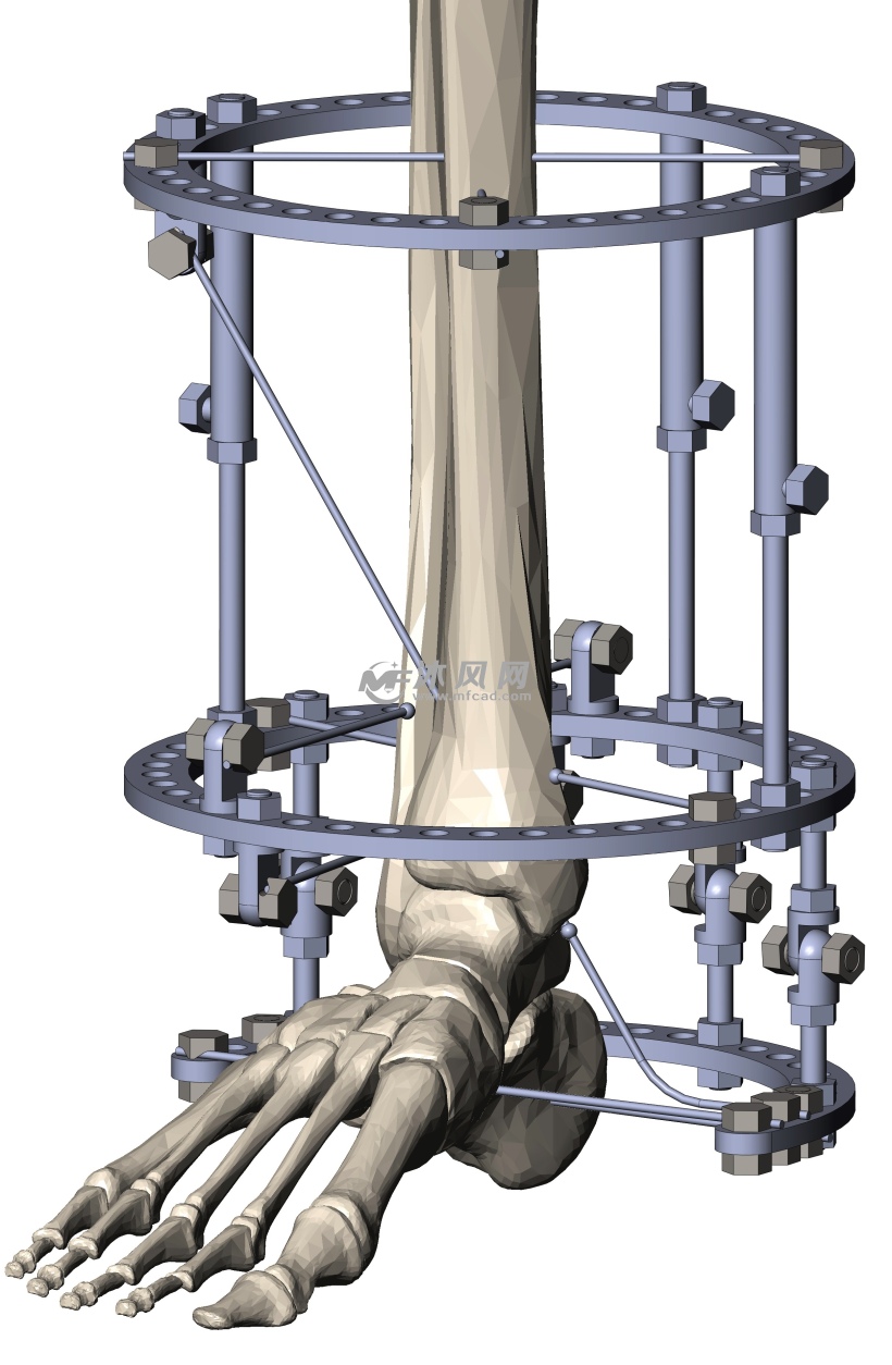 脚踝小腿骨骼医学外固定支架模型