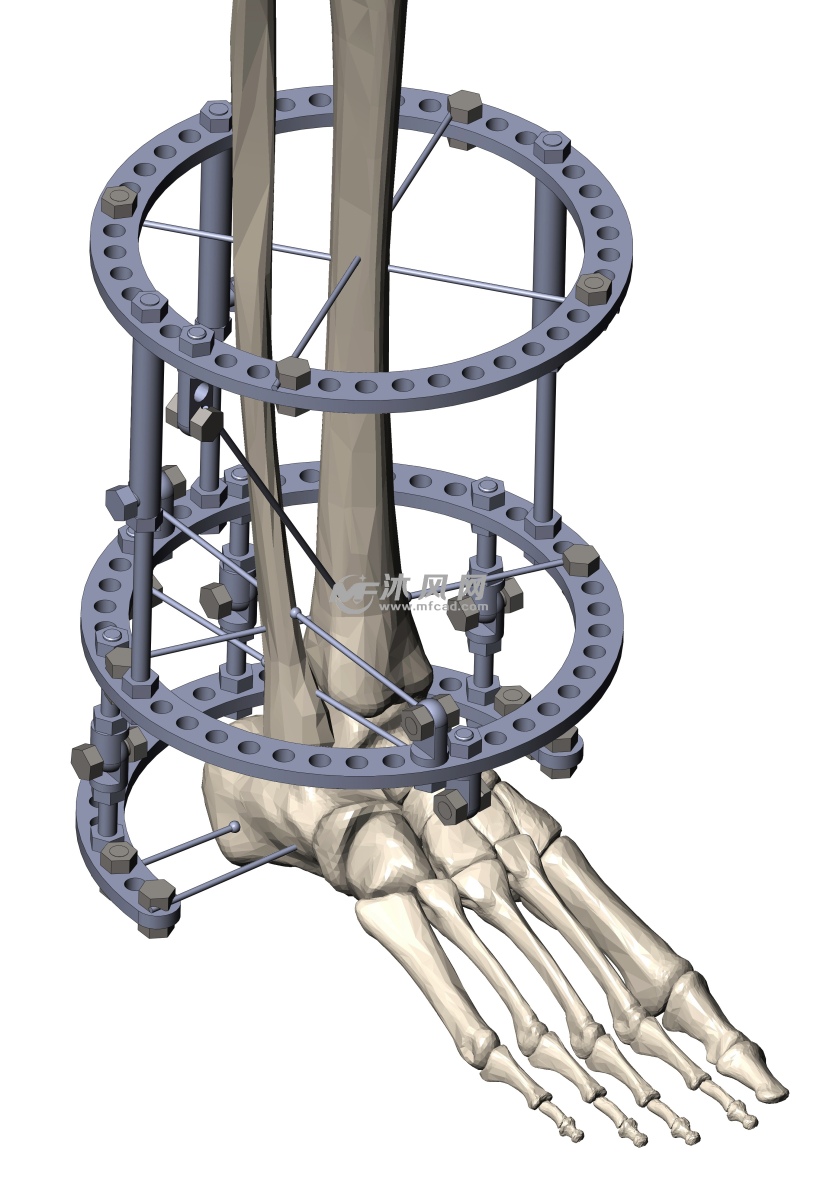 脚踝小腿骨骼医学外固定支架模型