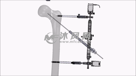 治疗股骨颈骨折的固定装置 - solidworks小五金