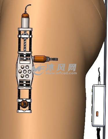 治疗股骨颈骨折的医疗设备 - solidworks生活用