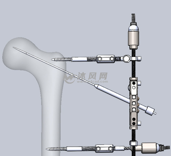 治疗股骨颈骨折的医疗设备 - solidworks生活用